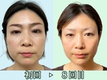 ナチュラルパーフェクトフェイス 新宿/４０代・左右差、エラ・口角歪み