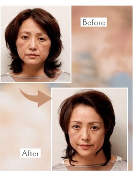 ピーチ ローズ(peach rose)の写真/話題のボワールリフティングが初回￥6,600～♪理想のフェイスラインへ筋肉からしっかり引き上げ☆