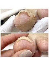 りく/巻き爪補正1ヵ所