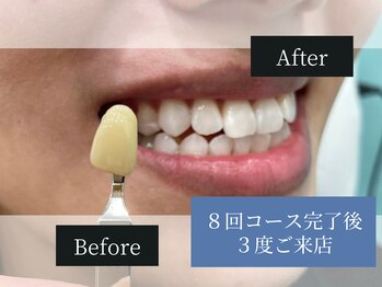 ホワイトニングカフェ 福岡天神店/◎歯のホワイトニング施術写真◎