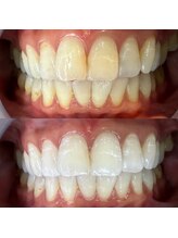 フフフ(Fff)/本格派セルフホワイトニング☆