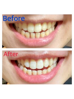 ホワイトサロン/Before→After