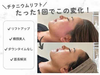 クレスト(CLEST.)/チタニウムリフトbefore/after