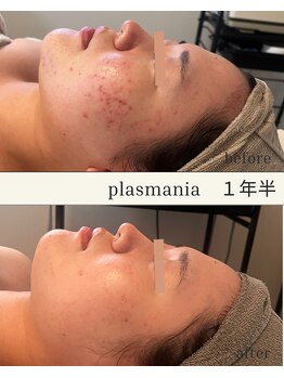 ビューティリュクス(beauty luxe)/繰り返す大人ニキビ