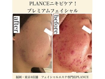 プランス 福岡(PLANCE)/福岡／ニキビケア/エステ／毛穴