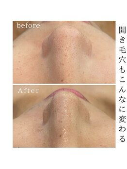 リノ(Lino)/開き毛穴にもアプローチ