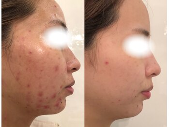 アネル 新都心店(anel)/ニキビケア　肌質改善　《那覇》