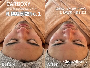 クリーンアンドビューティ 札幌(Clean&Beauty)/韓国カーボキシー札幌症例数No.1