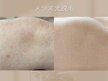 ミシェリ(MCHERI)/メンズ部分脱毛