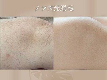 ミシェリ(MCHERI)/メンズ部分脱毛