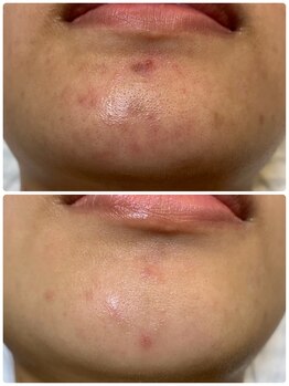 ジェニー(JENNI)/LDMコース　施術４回