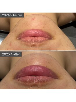 ロッタ エクリュ(Lotta ecru+)/REVI剥けないハーブピーリング