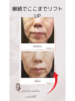 フェイシャルサロン セレスタイト/2カ月後の継続効果