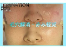 ヴィオール 名古屋栄店(VIOR)/毛穴つまりにお悩みならコレ！