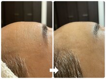 サロン ド ジョワ(salon de joie)/50代おでこ横しわ改善ピカピカ肌