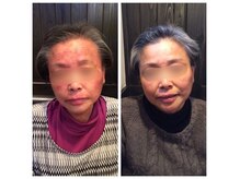 アスボーテ(ASBEAUTE)の雰囲気(60年間悩まれていた後天性乾燥肌の8ヶ月後)