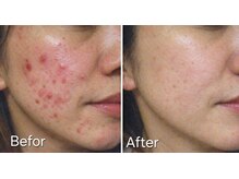 マロン(MARON)/【30代／頬にきび】改善例