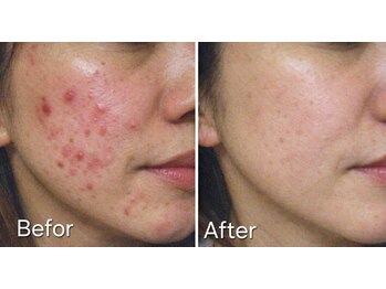 マロン(MARON)/【30代/頬にきび】改善例