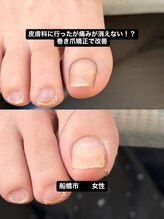 巻き爪じゅん 船橋店/介護中に多い巻き爪トラブル