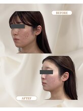 トロワ(TROIS)/土台から触る巡リフトで最強小顔