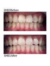 ホワイトニングショップ 三田店/ Before After/1回（初回体験）