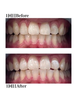 ホワイトニングショップ 三田店/ Before After/1回（初回体験）