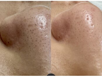 ルコル(LUCOL)/毛穴洗浄