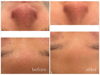 メゾンリュバン 天王寺(Maison Ruban)/ダクトピール|毛穴改善