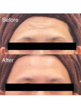 ブランシェ 野々市店 × 椿/シワ・たるみケア　お客様