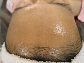 ビューティーメイクさくら/ポツポツ肌改善