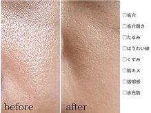 アンシャンテ 神戸元町店(Enchante)/毛穴洗浄ピーリングフェイシャル