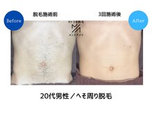 メンズアメリ/高知/メンズ脱毛/ヒゲ/全身/VIO