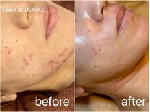 サロン ド ブラン アオヤマ(Salon de BLANC AOYAMA)/クリスティーナハーブピーリング