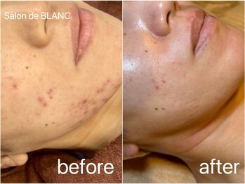 サロン ド ブラン アオヤマ(Salon de BLANC AOYAMA)/クリスティーナハーブピーリング