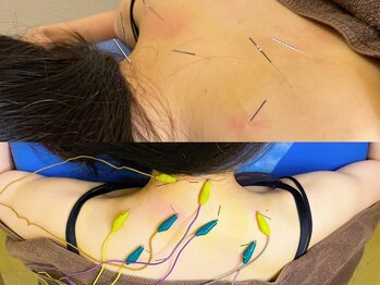 恵比寿駅前整骨院はり院 別館/肩コリ　眼精疲労　マッサージ