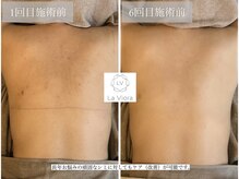 ラヴィオーラ 名駅(LaViora)/ダイヤモンドハーブピーリング