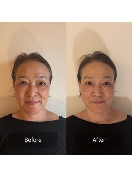 かぐや(salon)/ビフォアフ：「香り蒸」後の施術