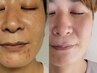 【生理前のニキビ専門】ゆらぐ肌に|肌質改善ケア60分