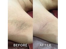 ヴァーチュ(Virtue)/【エステ】脇脱毛