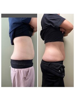 マイティー整骨院 ココア(CoCoa)/痩身マシン