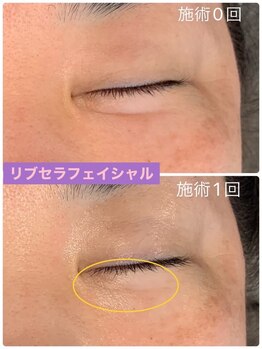 プリュネル(Prunelle)/プラズマシャワー