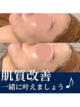 プレジール(plasir)/ハーブピーリング2回での結果