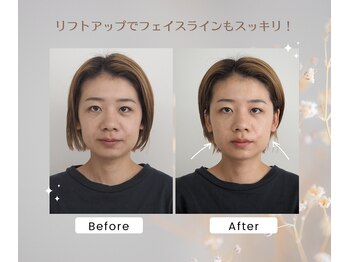 さかうえ接骨院/BF/AF美容鍼