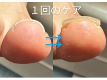 バンビーナネイル(Banbina Nail)の雰囲気（巻き爪ケアしてからフットネイルも可能です！）