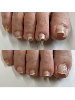 リリ(lili)/巻き爪矯正1回目(右親指)