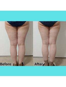 ホワイトビューティーラボ(White Beauty Lab)/足脂肪冷却