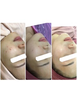 毛穴ケアをしたい