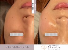 シエスタ(siesta)/セルマン艶玉肌トリートメント