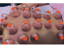 スイクウ ネオ(neo)/男性もOK！人気のカッピング吸玉