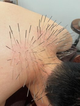 鍼灸施術を受けたい